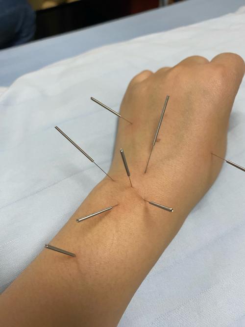 性功能障碍针灸位置