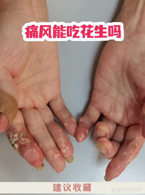 痛风可以吃芝麻油吗