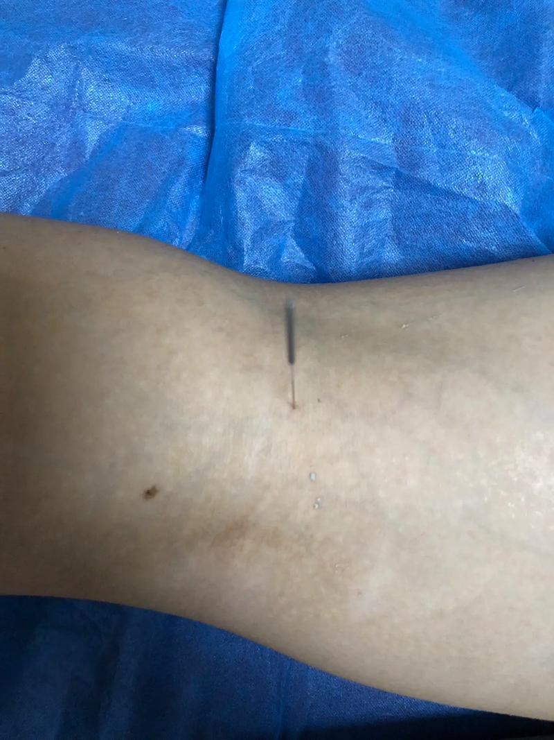 瘦腰的方法针灸减肥