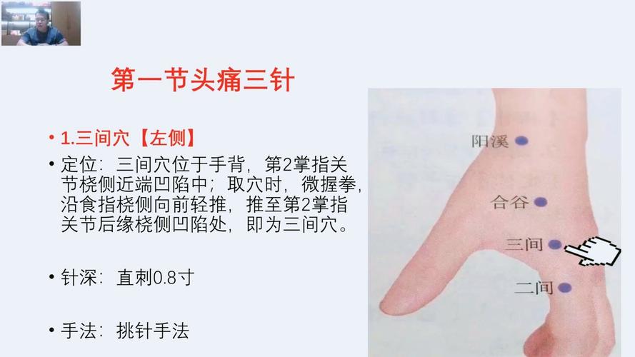 偏头痛针灸哪个穴位