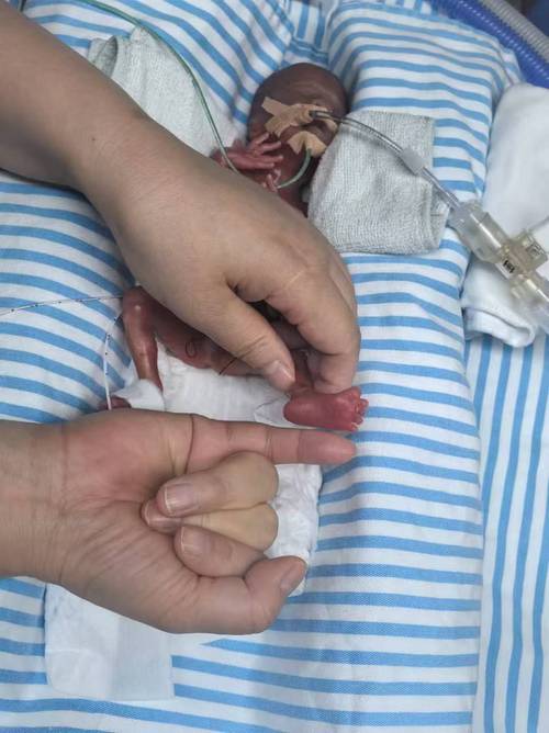 早产儿激素脱氧安全吗