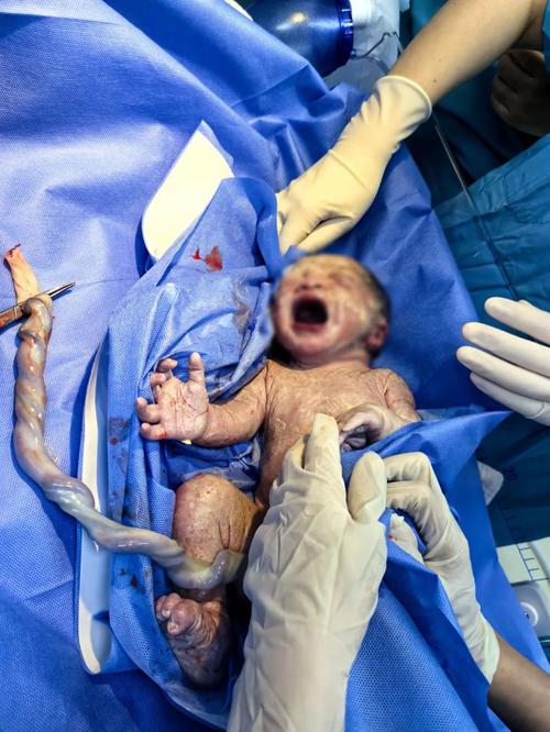 早产儿激素脱氧安全吗