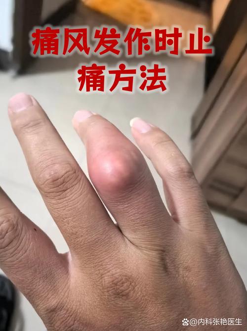 美国人如何治疗痛风