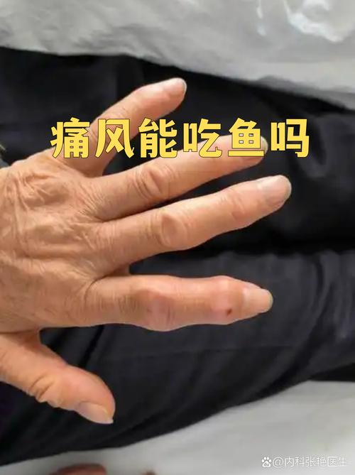 痛风能吃有鳞的鱼吗