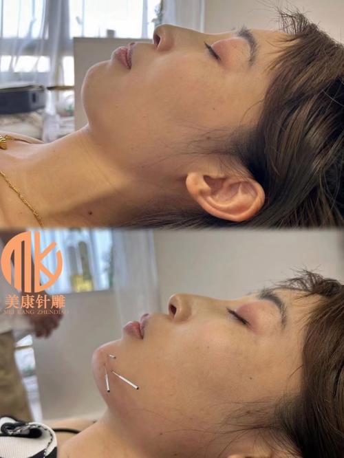 针灸美雕几次见效果