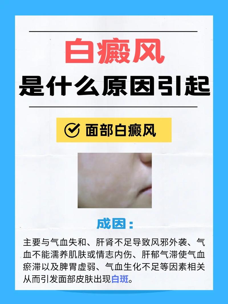 安全治疗白驳风的方法