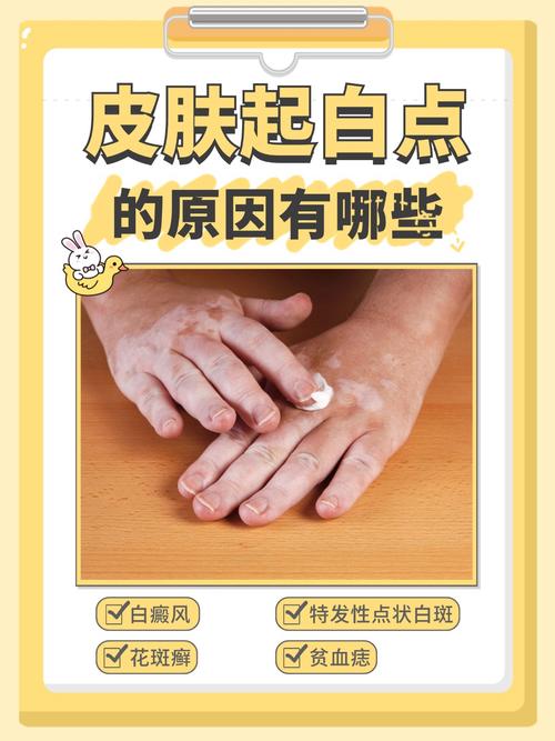 安全治疗白驳风的方法