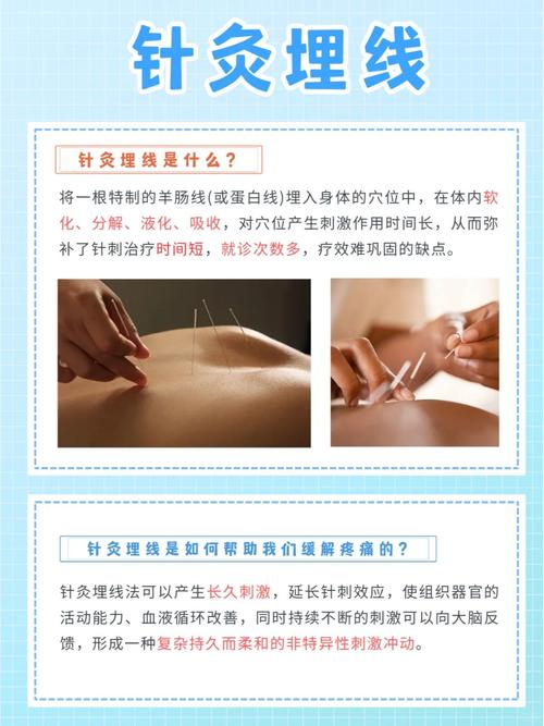 针灸埋线会推迟月经