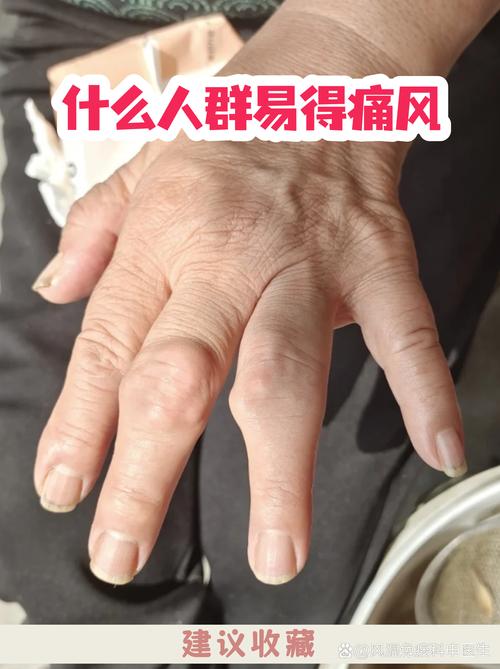 轻度血脂高血压痛风