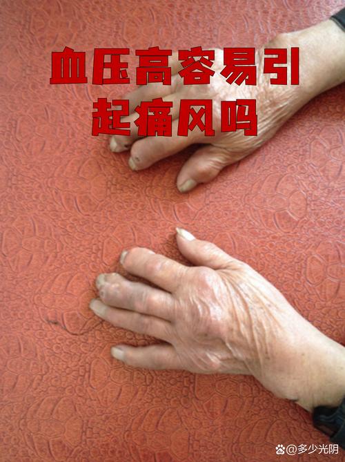 轻度血脂高血压痛风