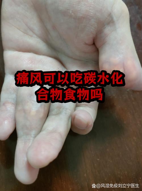 痛风可以吃番茄酱吗