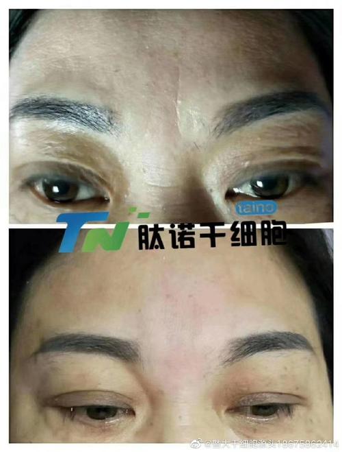 暨大干细胞填充安全吗