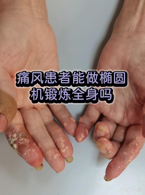 痛风病人能要孩子吗