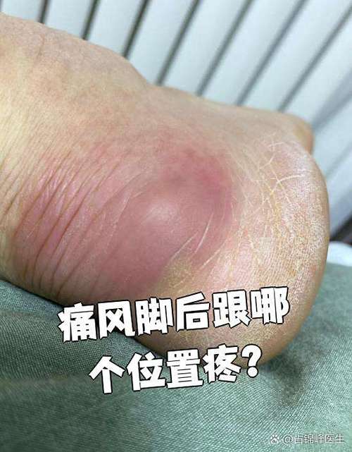 脚后跟疼肿是痛风吗