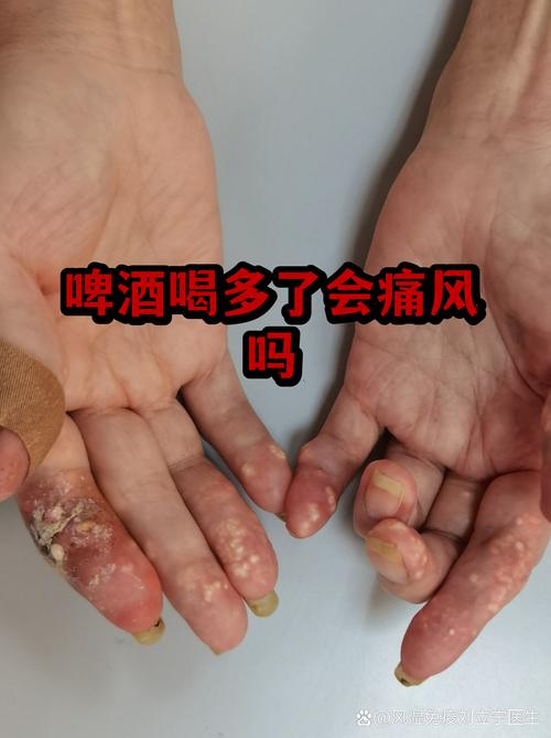 痛风偶尔喝一次啤酒