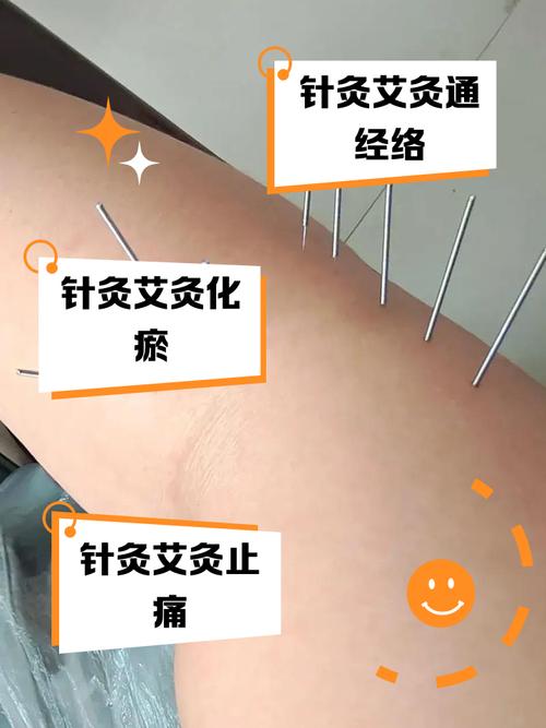 扎针灸后可以艾灸吗