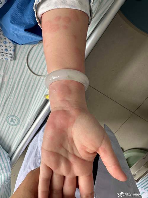 针灸会引起皮肤过敏