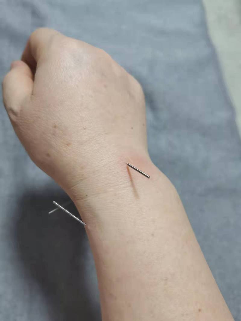 慢性湿疹针灸有用吗