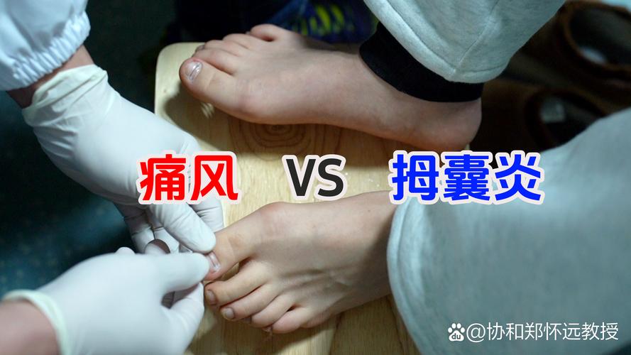 痛风和拇囊炎的区别