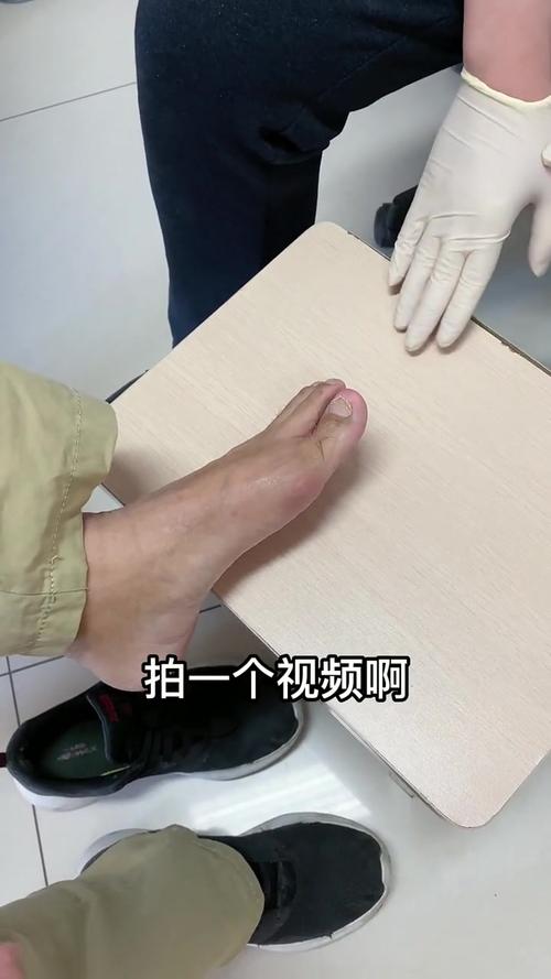 痛风和拇囊炎的区别