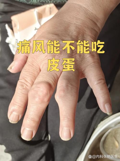 痛风能吃皮蛋盐蛋吗
