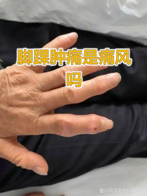 脚脖子筋疼是痛风么