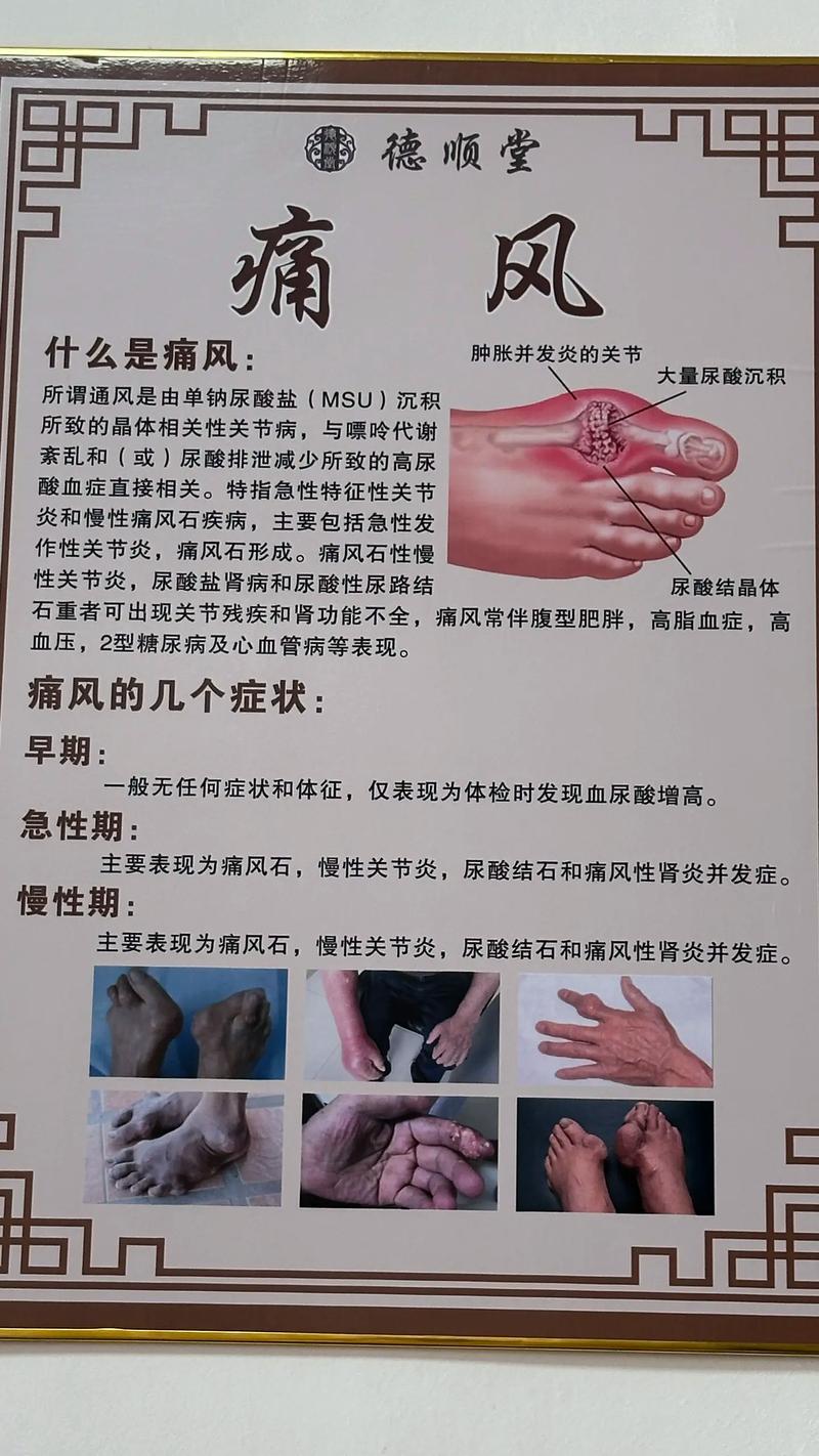 痛风分为哪几种类型