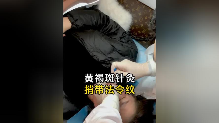 针灸淡化黄褐斑视频