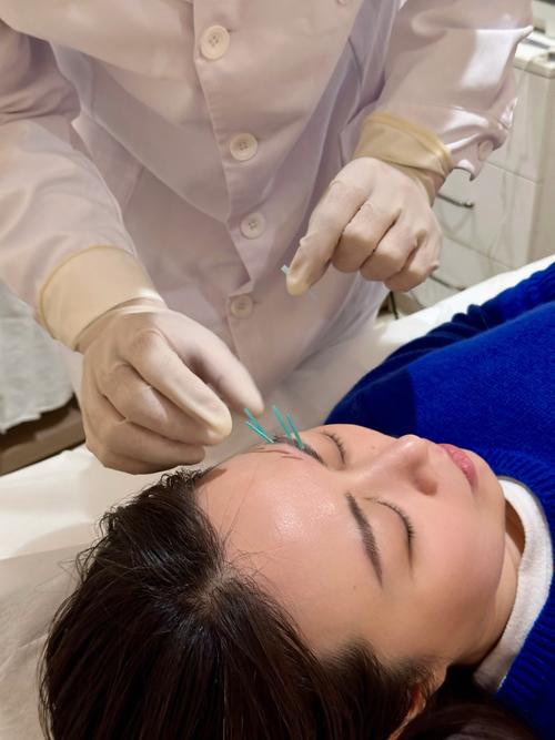 针灸淡化黄褐斑视频