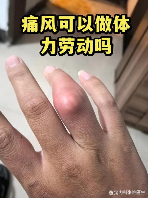 痛风病人能生孩子吗