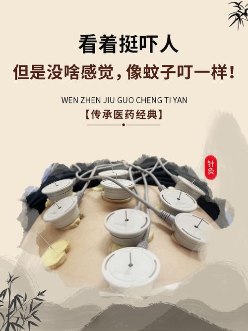 针灸减肥需要封针吗