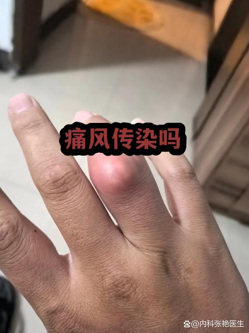 哺乳期痛风会自愈吗