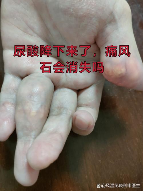 哺乳期痛风会自愈吗