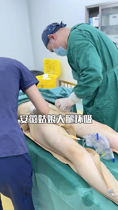 做腿部吸脂手术安全吗