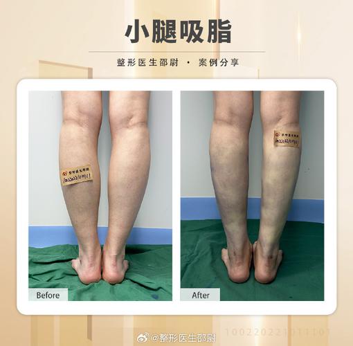 做腿部吸脂手术安全吗