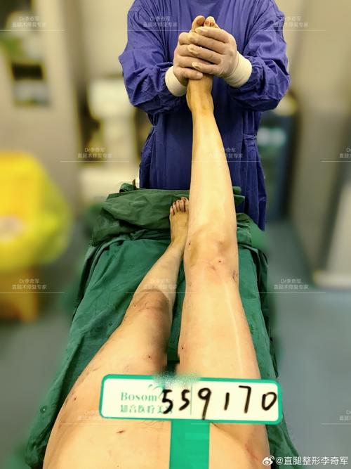 做腿部吸脂手术安全吗