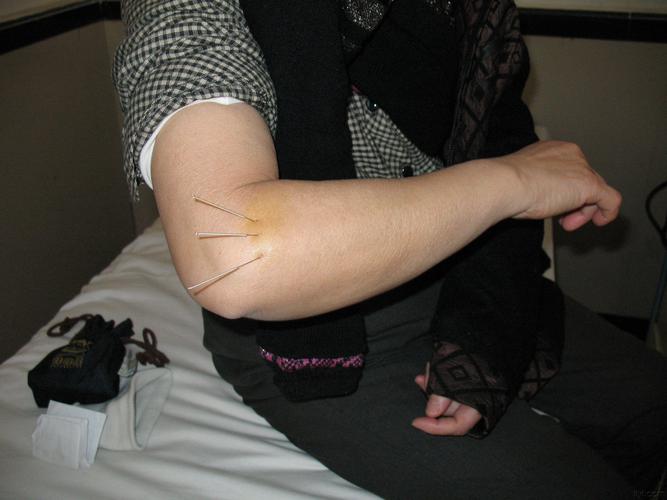 针灸能治韧带损伤吗