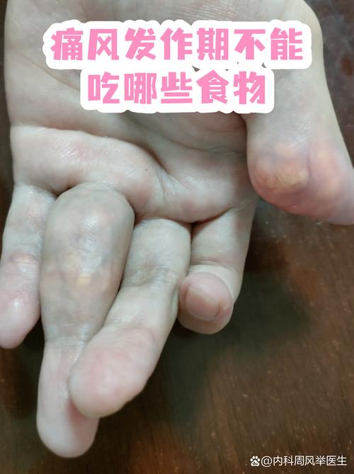 痛风发作期能吃肉吗