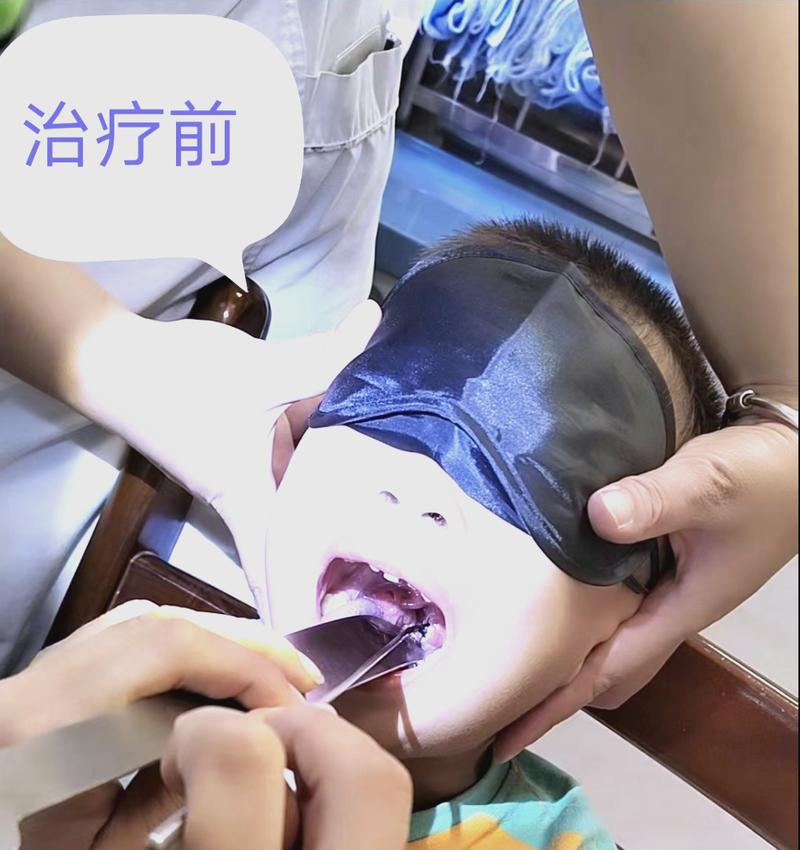 针灸治疗扁桃体肿大