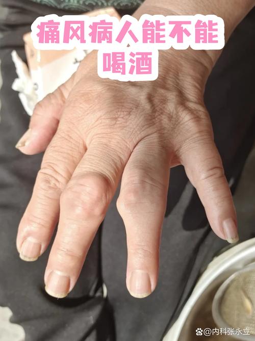 痛风可以用酒精擦吗