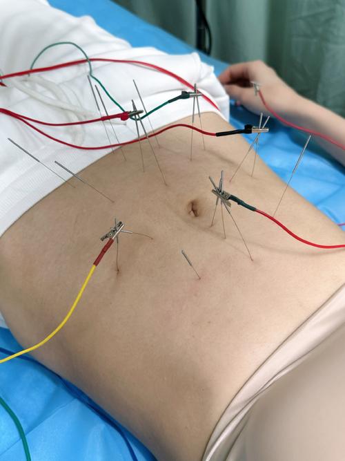 神经性呕吐针灸治疗