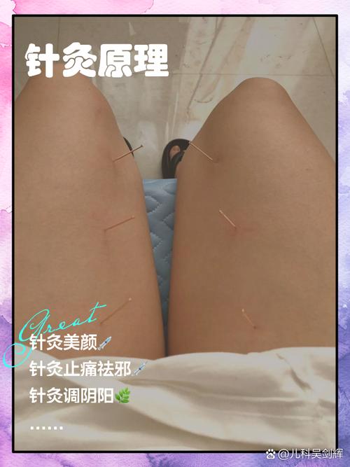 针灸治疗更年期潮红