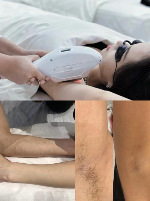 激光脱毛上海美莱安全