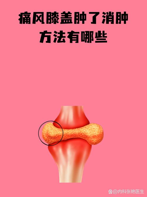 痛风会影响膝关节吗