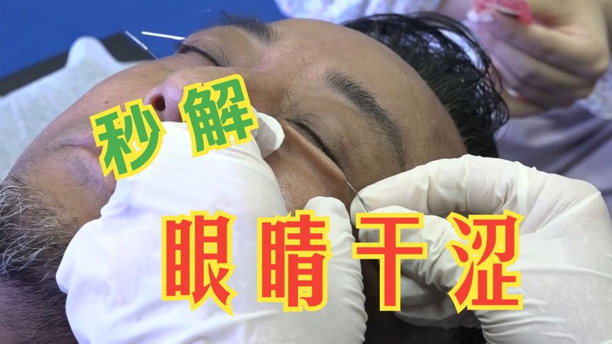 神经性眼部针灸好吗