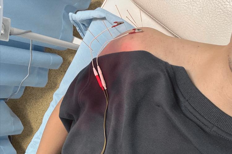 肩关节后伸受限针灸