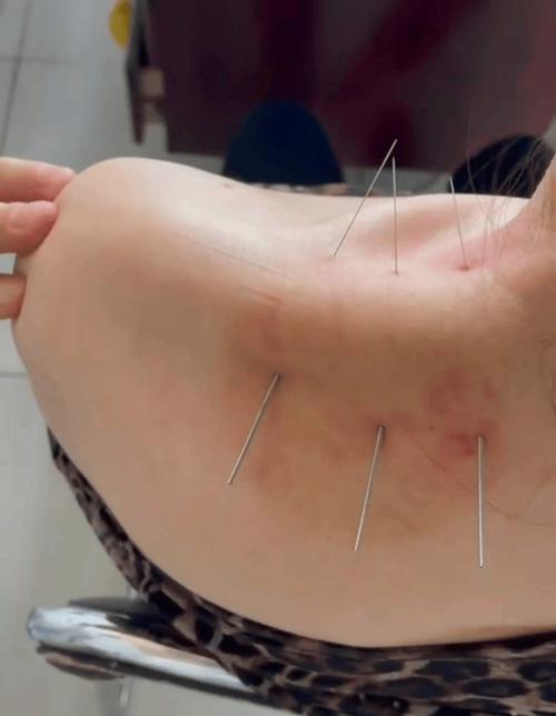 肩关节后伸受限针灸