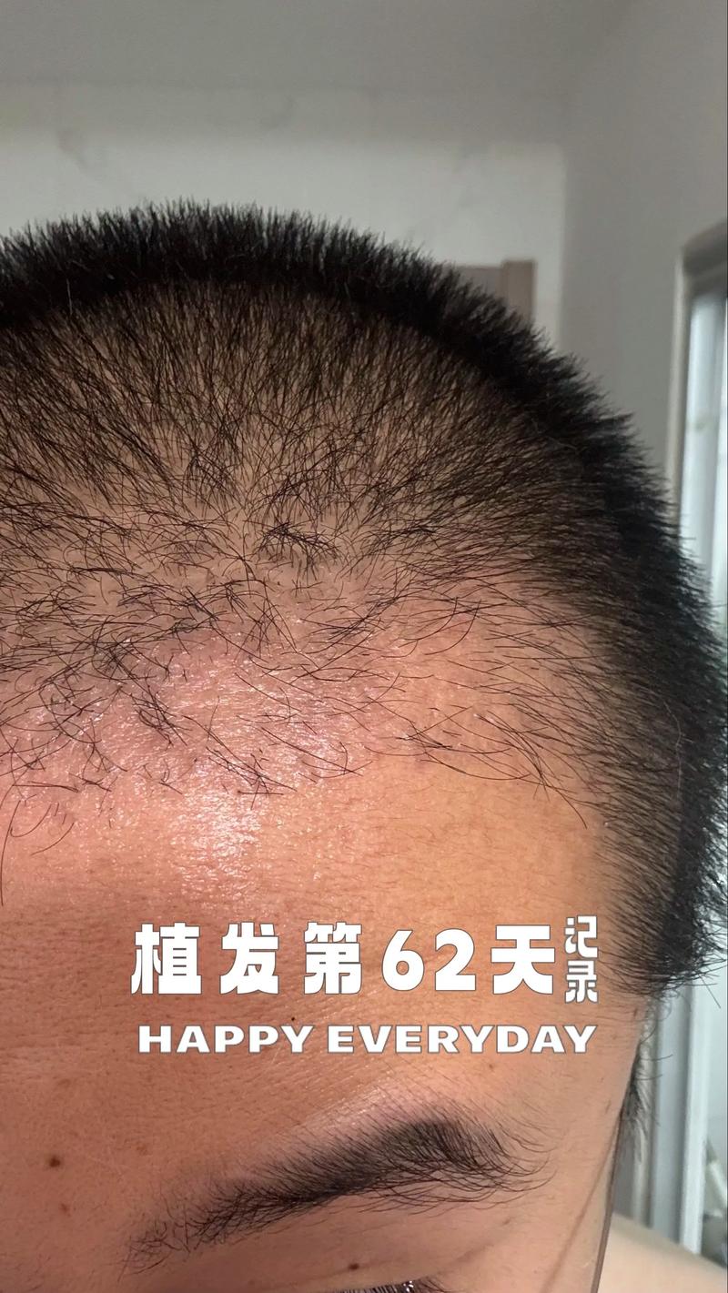 植发医院海峡植发安全