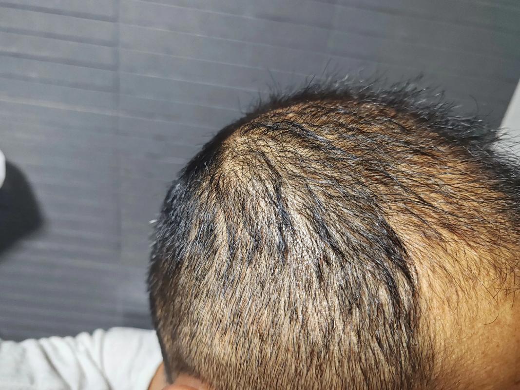 植发医院海峡植发安全