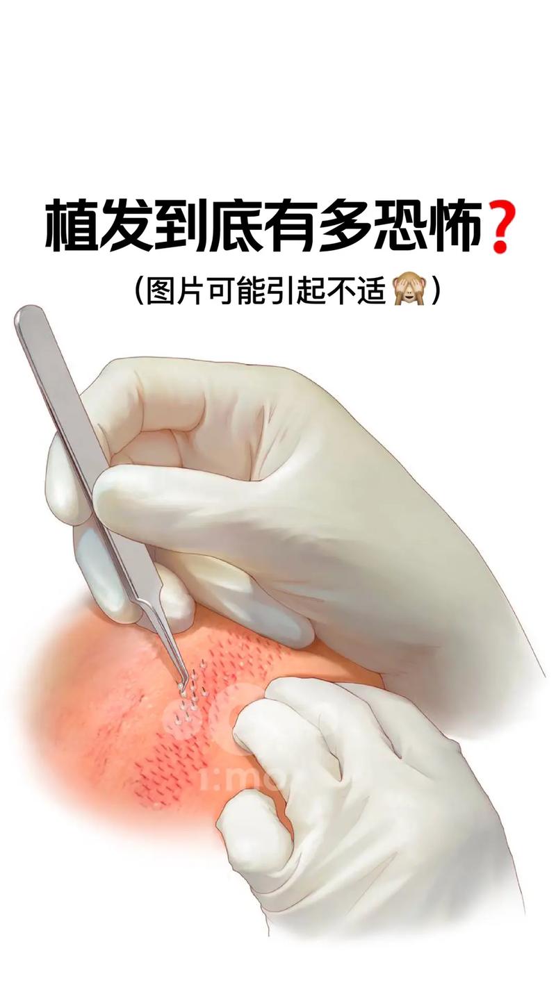 植发医院海峡植发安全